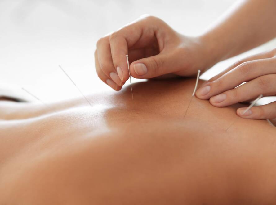 Acupuncture