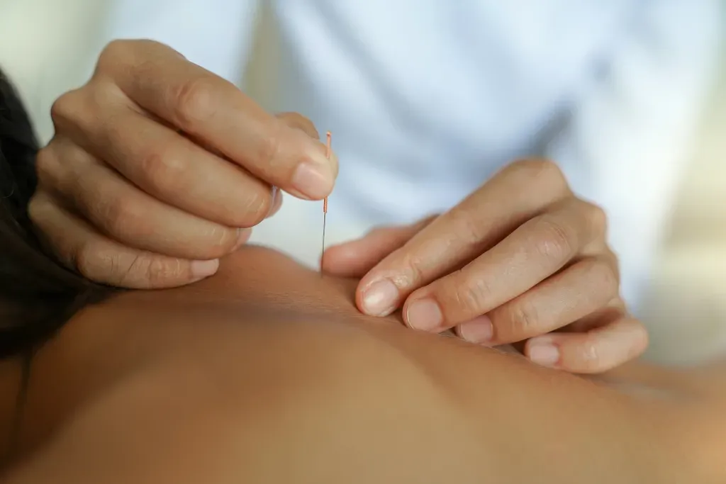 Dry Needling
